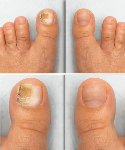Foot mushrooms - before and after treatment with body cream