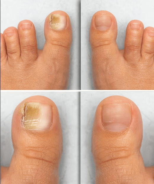 Fungus on the feet - before and after treatment with Fungent cream