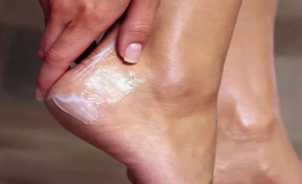How to treat Foot Mantargus with fungent cream