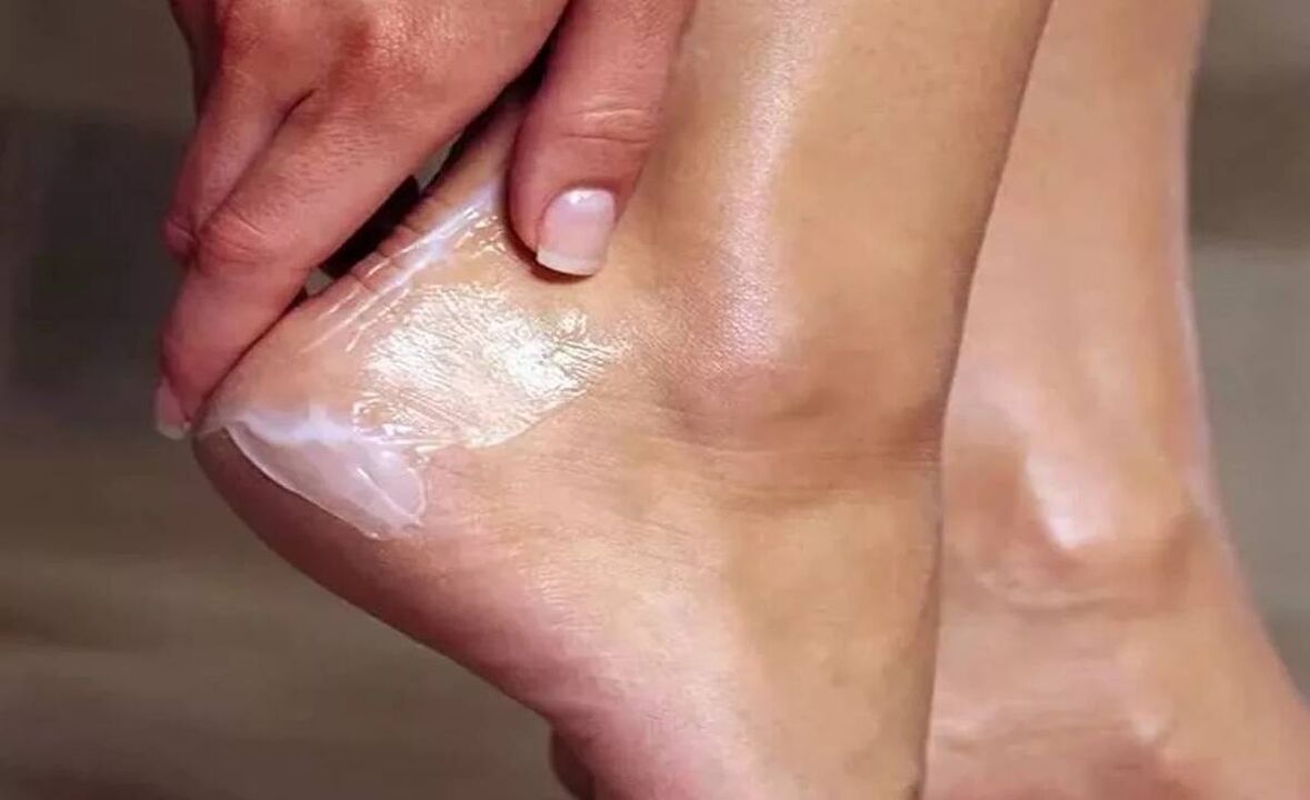 How to treat foot fungus with cream Fungent