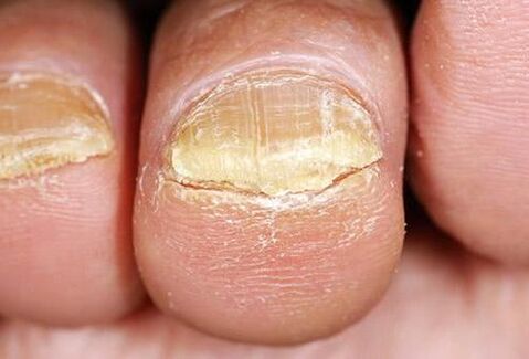 toenail fungus symptoms