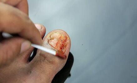 Fungus lesion