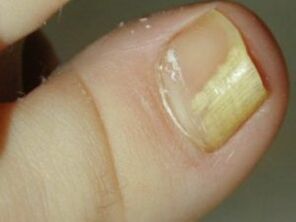 Nail -nail
