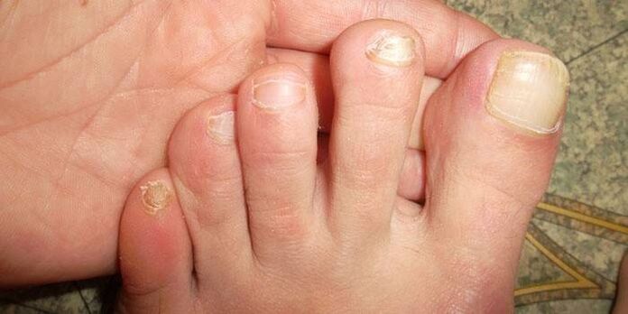 Update the nail after injury