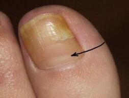 How to recognize the presence of a fungus of the toenails of the leg