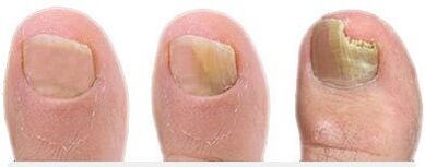 Stages of the development of fungi on the nails