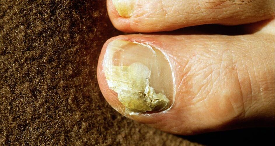 Foot fungus