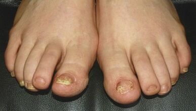 Signs and symptoms of fungi on the nails