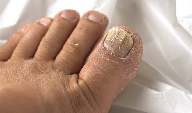 Distribution of mycosis lesion to nails