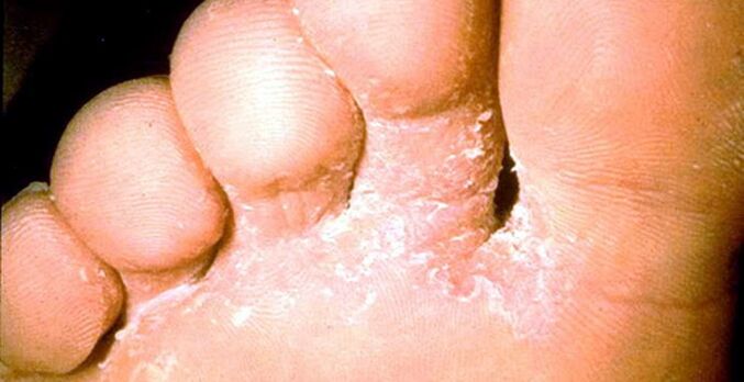 Lesion of skin fungi between the toes