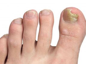 Yellow spots on the nails of the fungus signatures