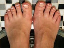 fungus on the nails and skin of the feet