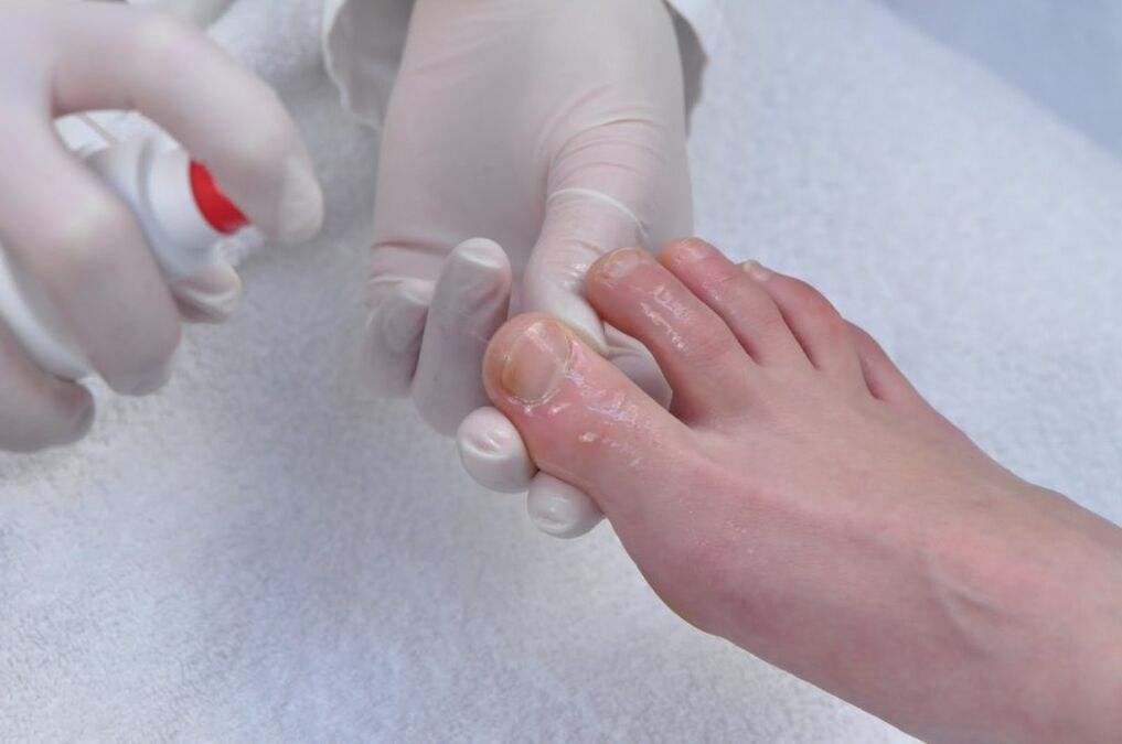 Treating fungal toes with an antifungal medication