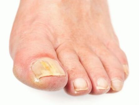 fungal nail damage