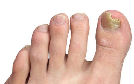 fungus on the nails of the big toe