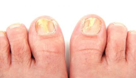 manifestations of fungus on the toenails