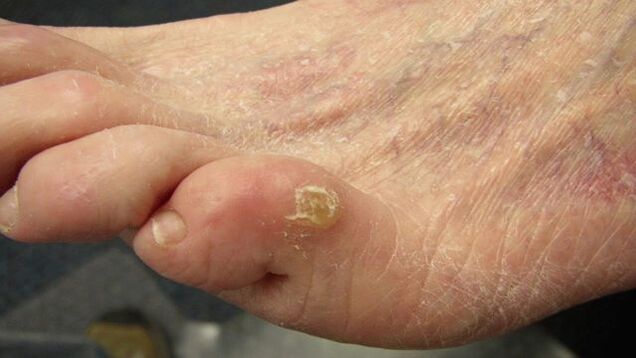 advanced stage of fungus