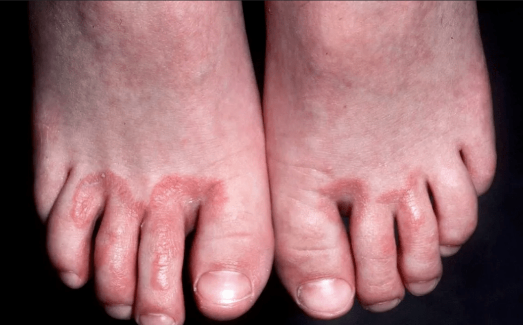 complications from nail fungus
