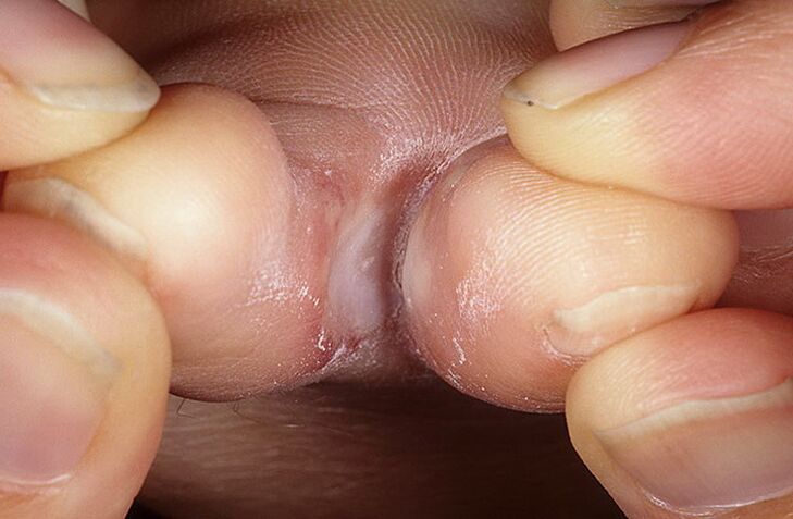 squamous-hyperkeratous form of the fungus