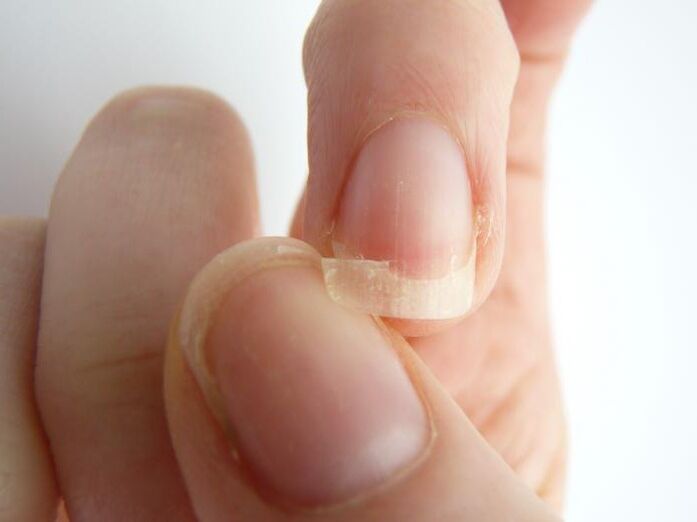 Nail exfoliation due to fungus