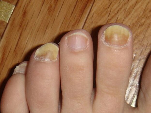toenail fungus symptoms