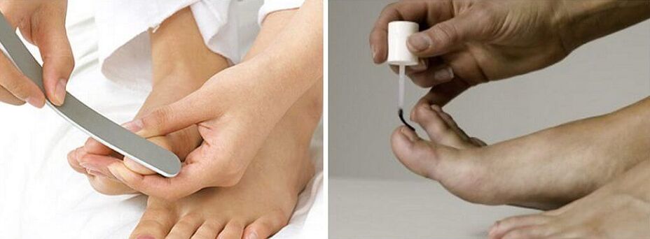 treatment of toenail fungus with nail polish